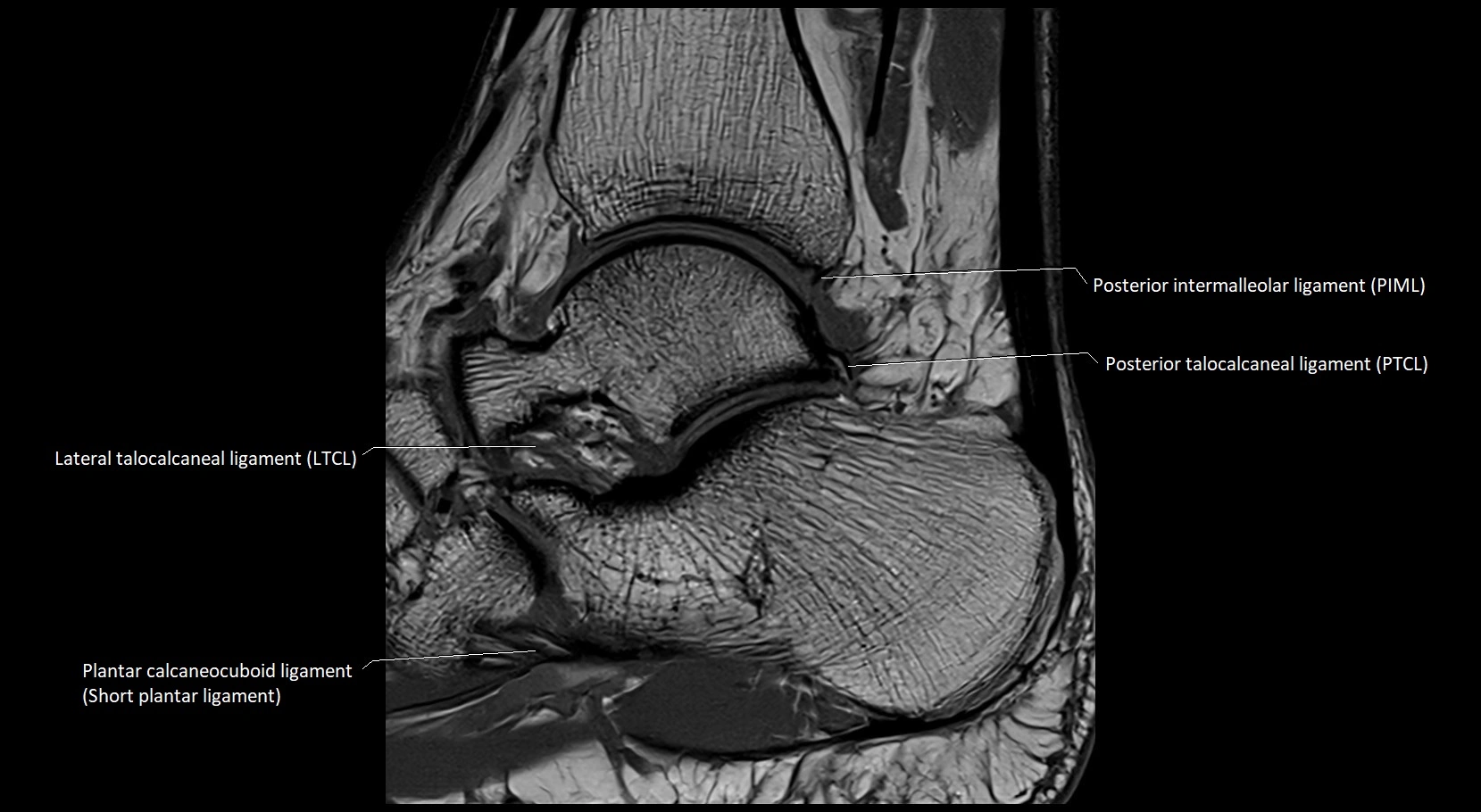 MRI ankle ligaments anatomy sagittal 3T image 15.webp